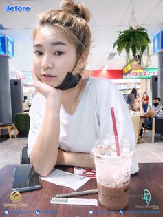 รีวิว เสริมจมูก20-2 CenturyClinic