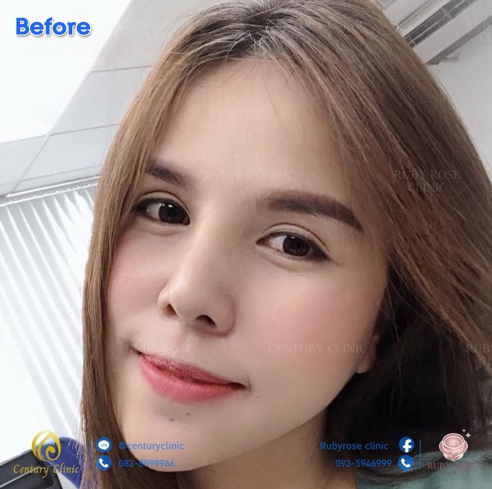 รีวิว แก้จมูก15-2 CenturyClinic