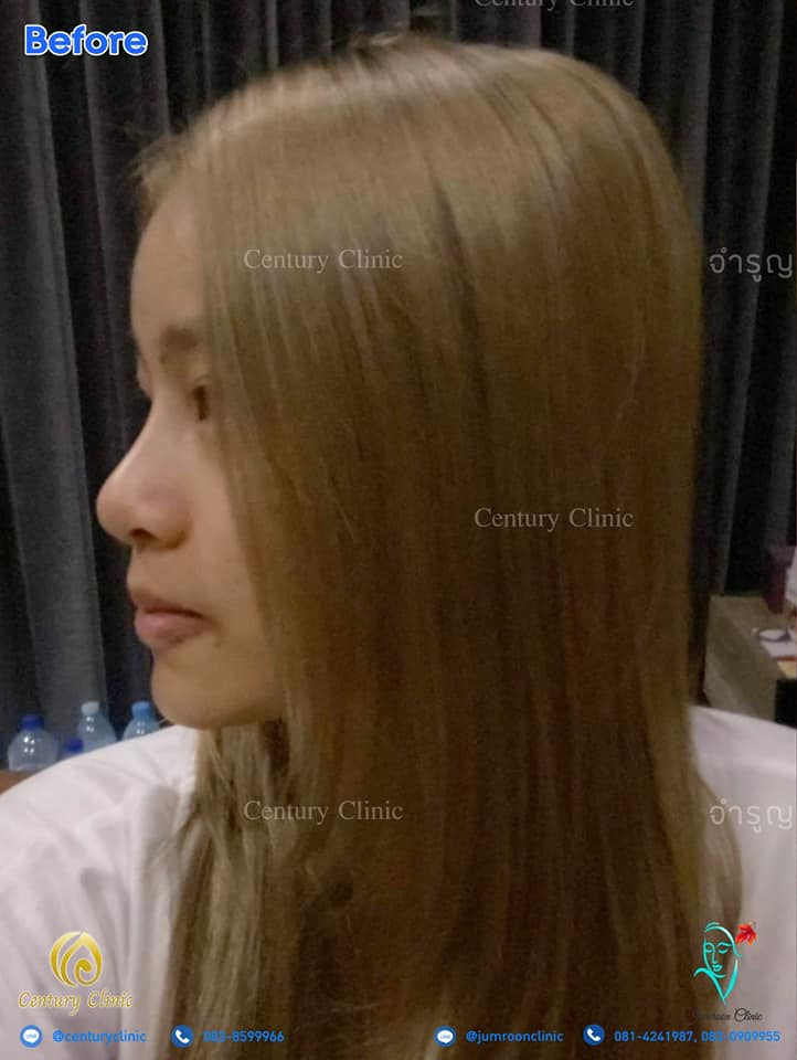รีวิว แก้จมูก16-2 CenturyClinic