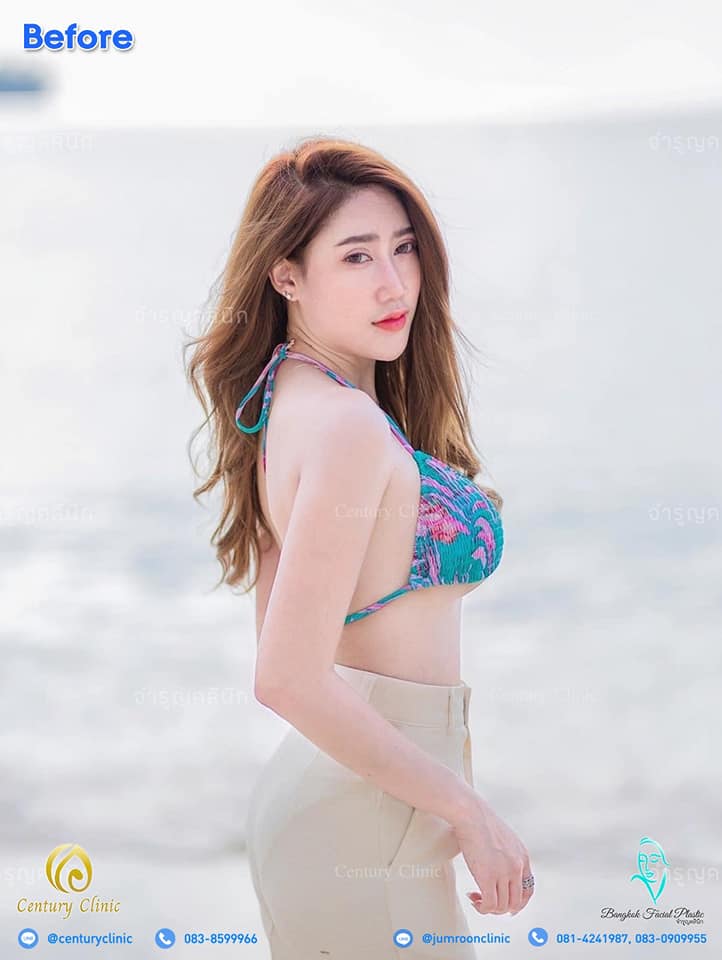รีวิว แก้จมูก19-3 CenturyClinic