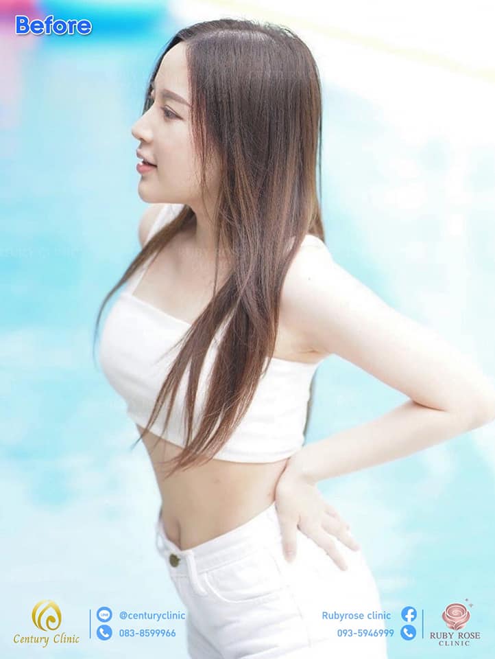 รีวิว แก้จมูก21-3 CenturyClinic