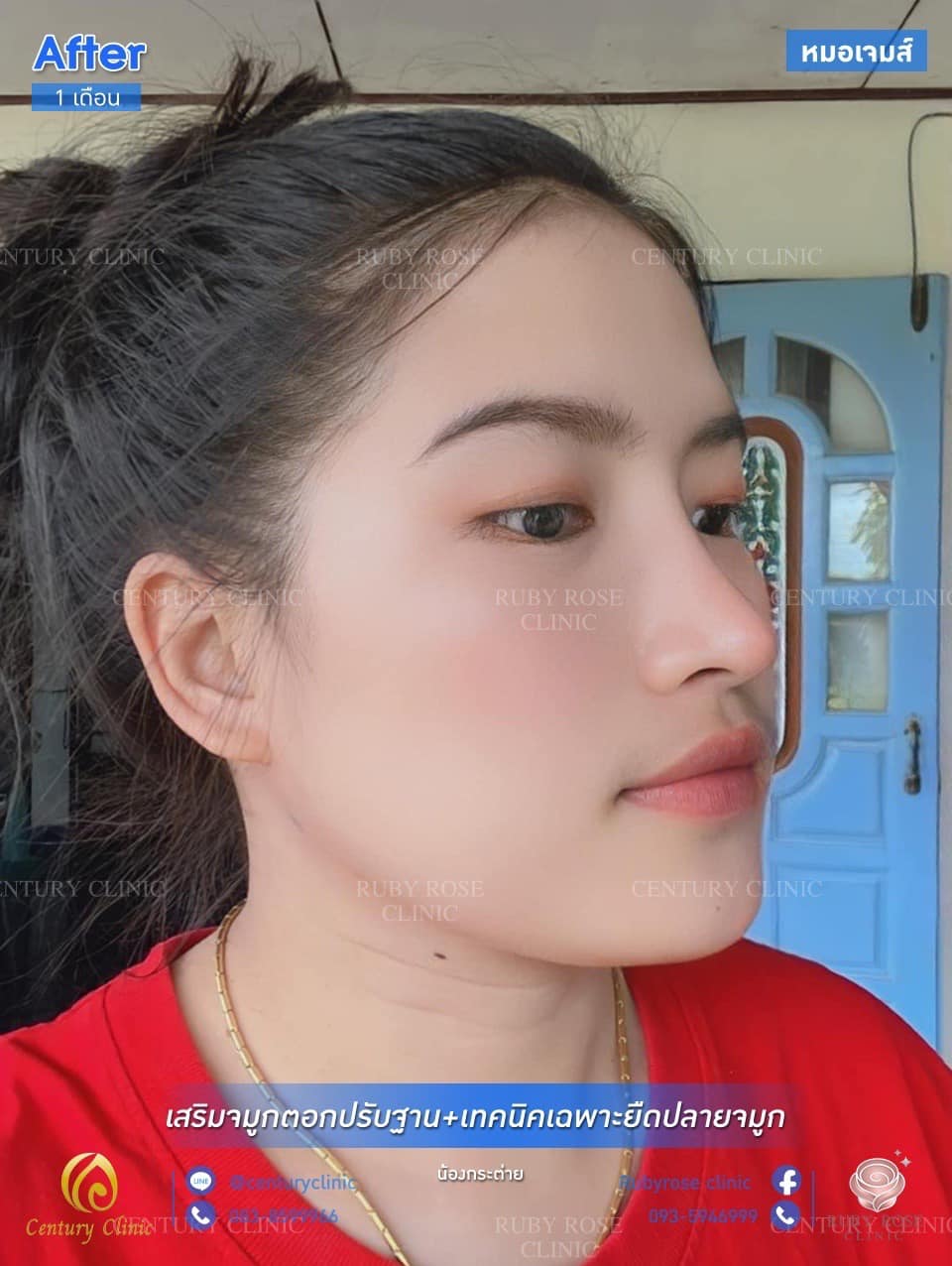 Century รีวิว เสริมจมูก #138