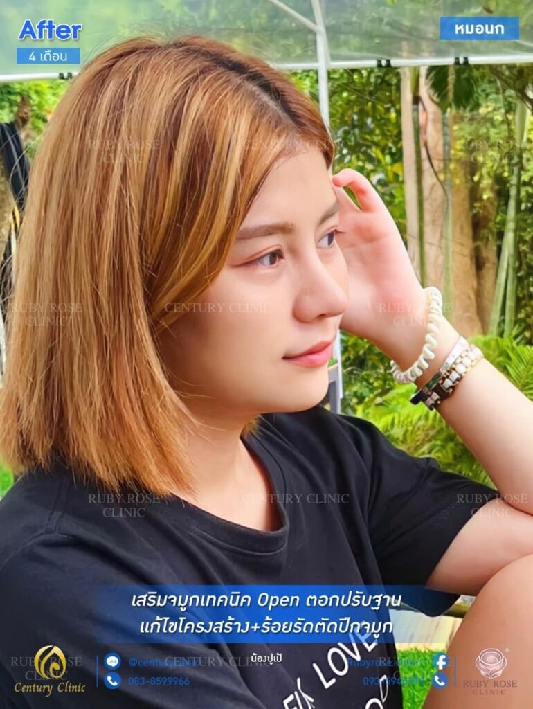 Century รีวิว เสริมจมูก1 #140