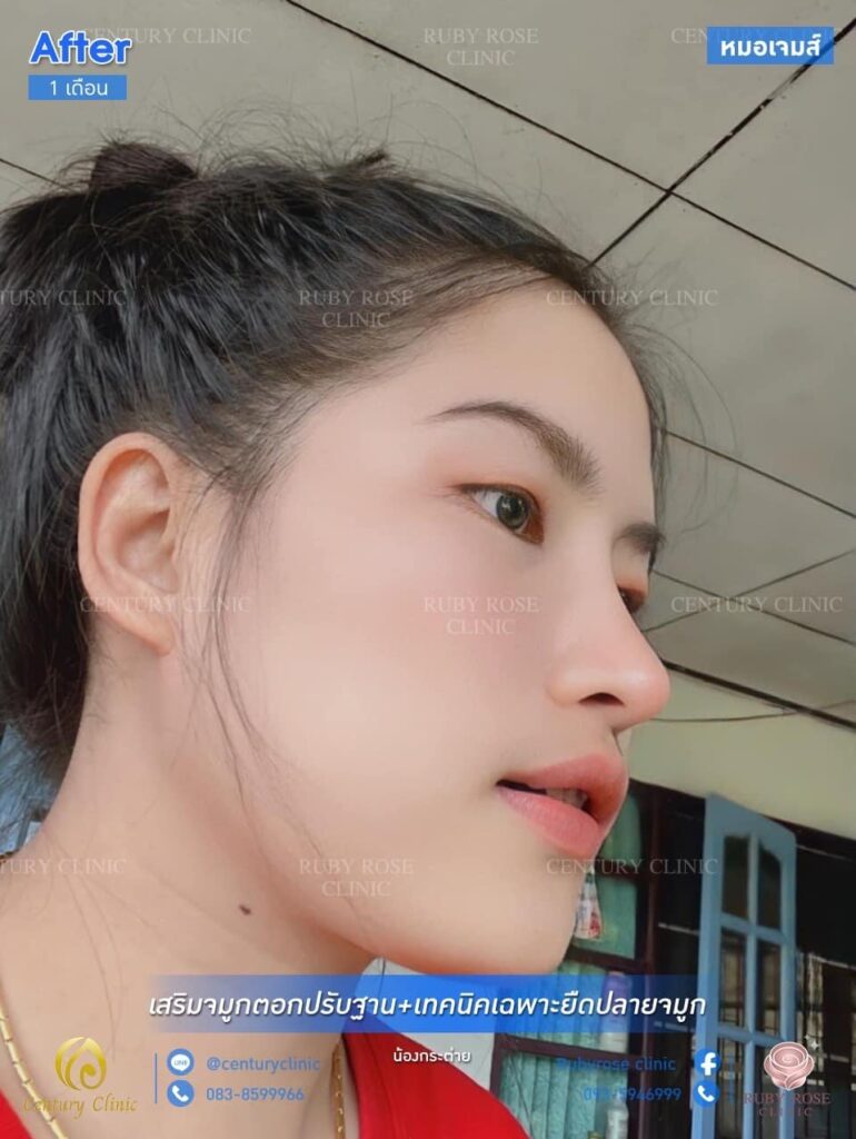 Century รีวิว เสริมจมูก2 #138