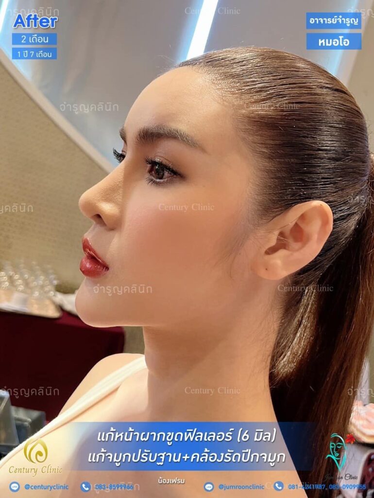 Century รีวิว แก้จมูก 1 #150