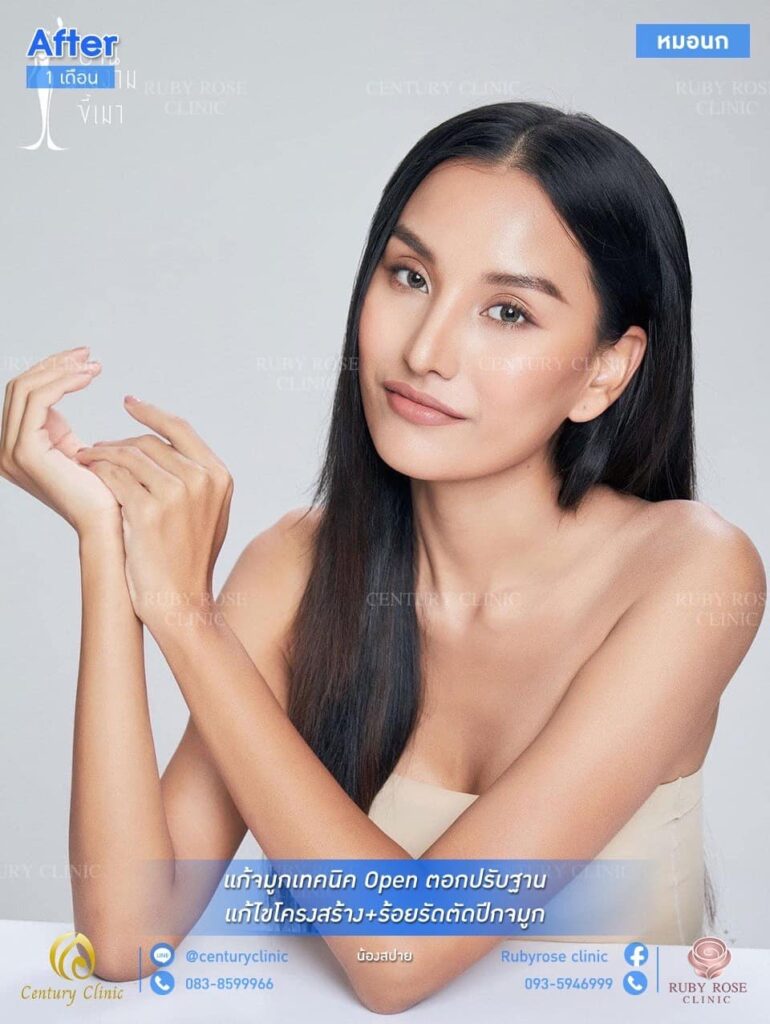 รีวิว แก้จมูก #135 , Century Clinic Thailand Century รีวิว แก้จมูก 1#135