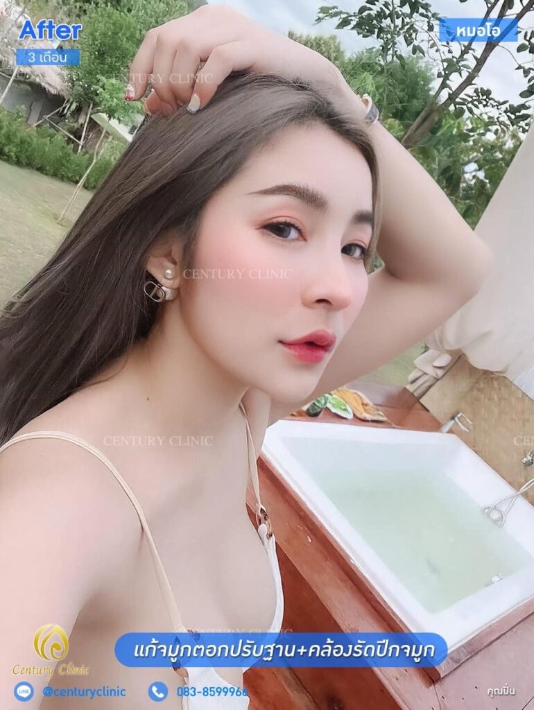 Century รีวิว แก้จมูก 1#142