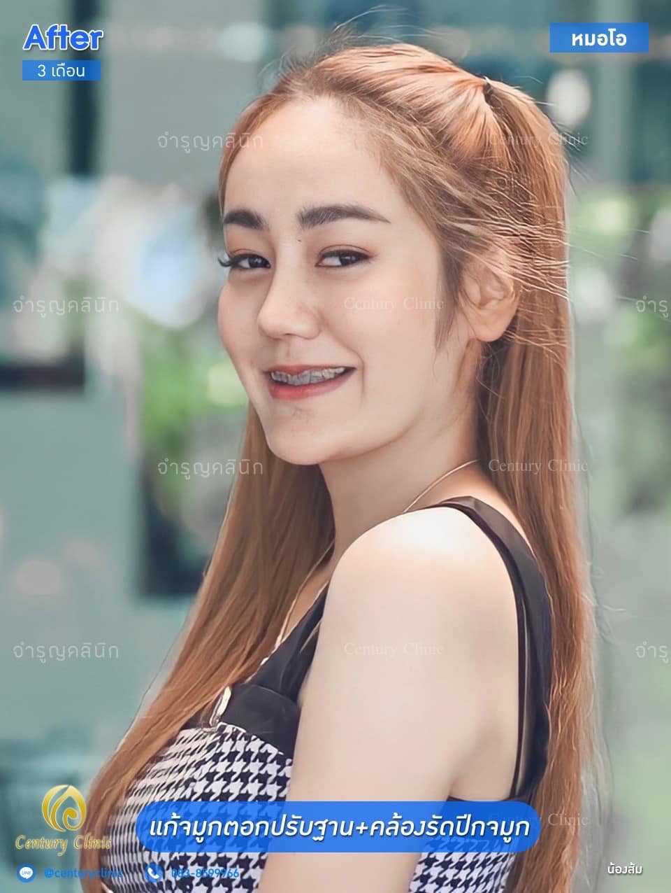 Century รีวิว แก้จมูก #136