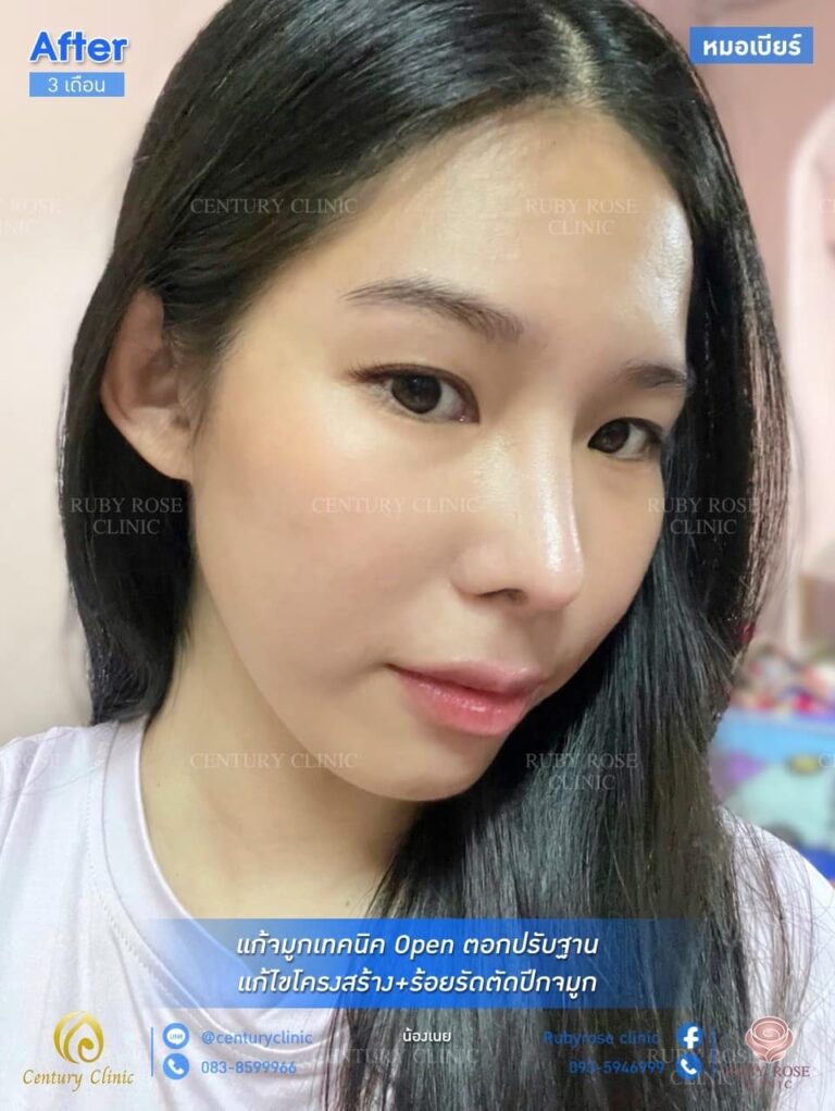 Century รีวิว แก้จมูก #137