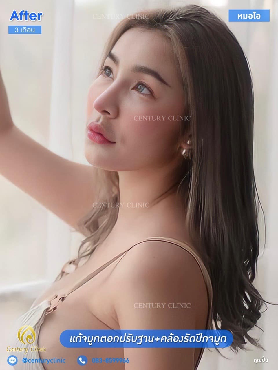 Century รีวิว แก้จมูก #142