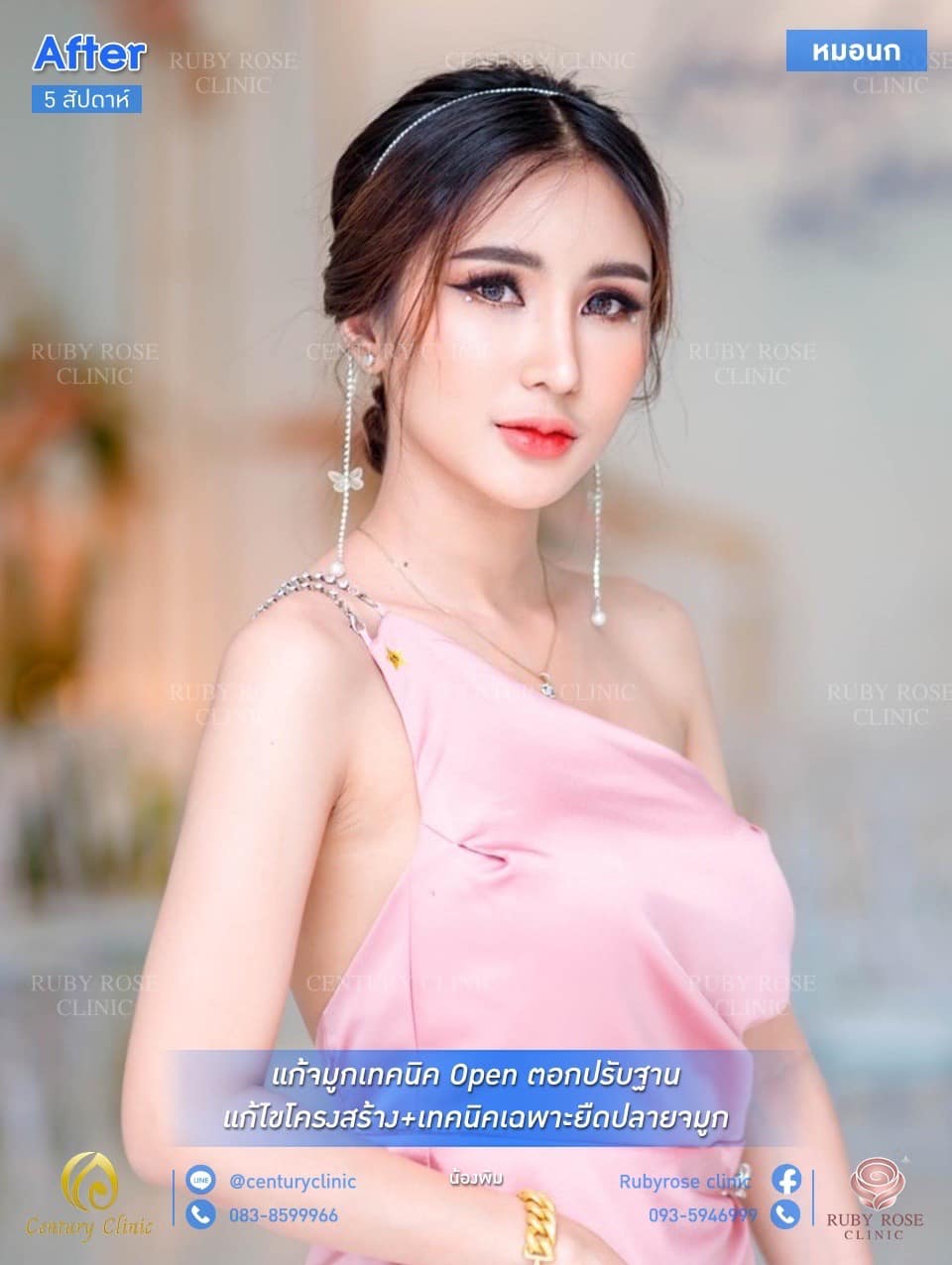 รีวิว แก้จมูก #144 , Century Clinic Thailand Century รีวิว แก้จมูก #144