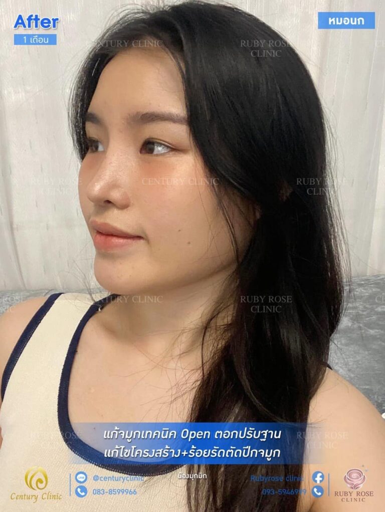 Century รีวิว แก้จมูก #149