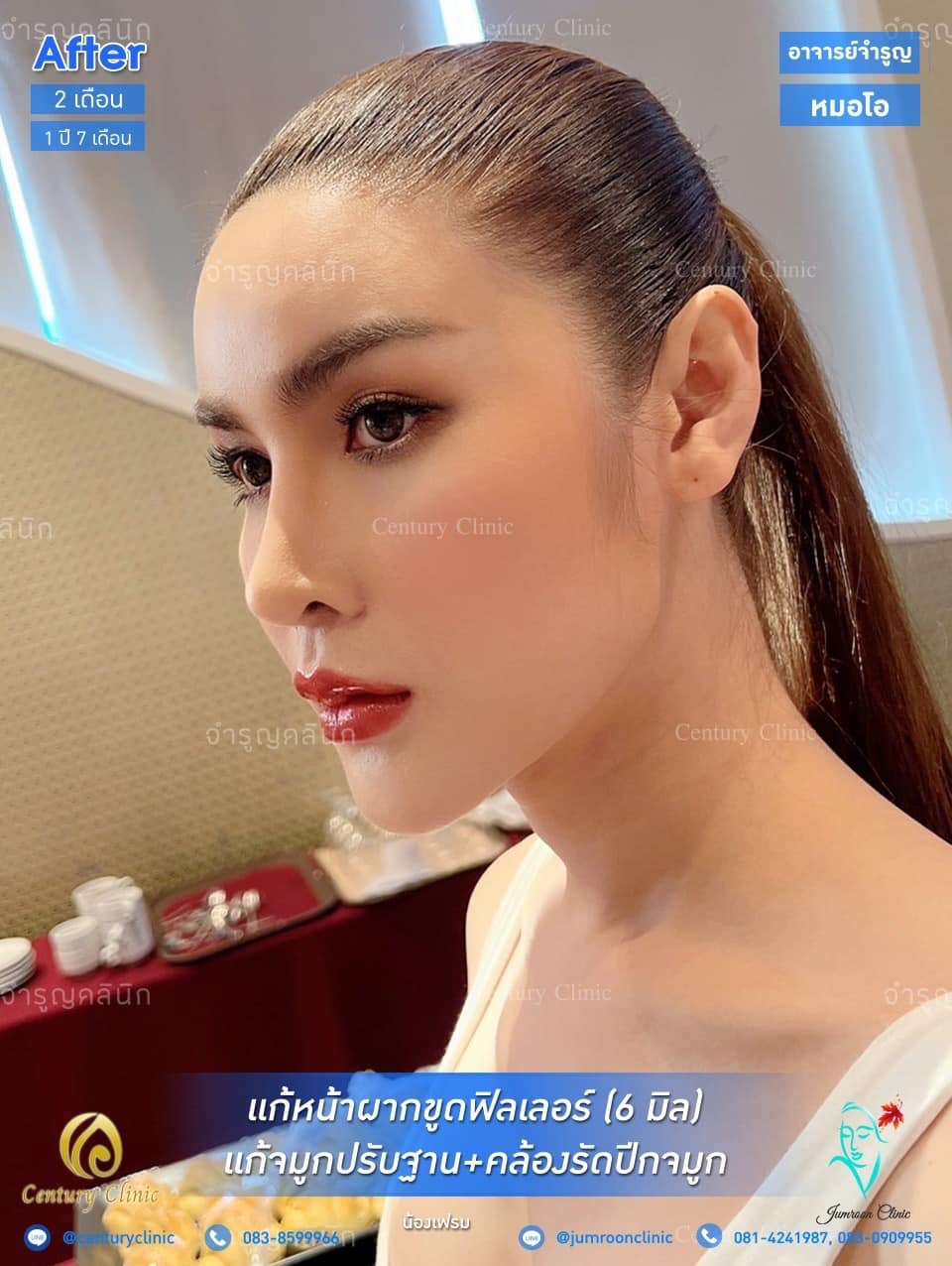 Century รีวิว แก้จมูก #150