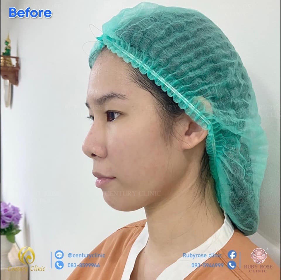 รีวิว แก้จมูก #137 , Century Clinic Thailand Century รีวิว แก้จมูก1 #137