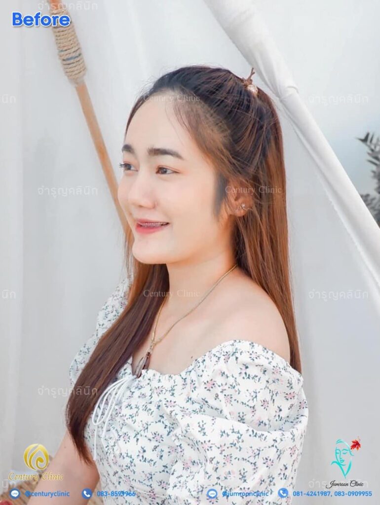Century รีวิว แก้จมูก2 #136