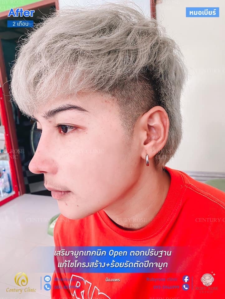 รีวิว เสริมจมูก #108