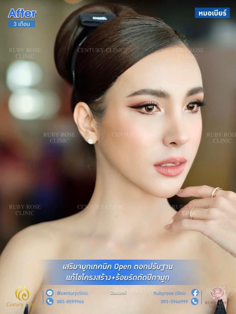 รีวิว เสริมจมูก 1#129