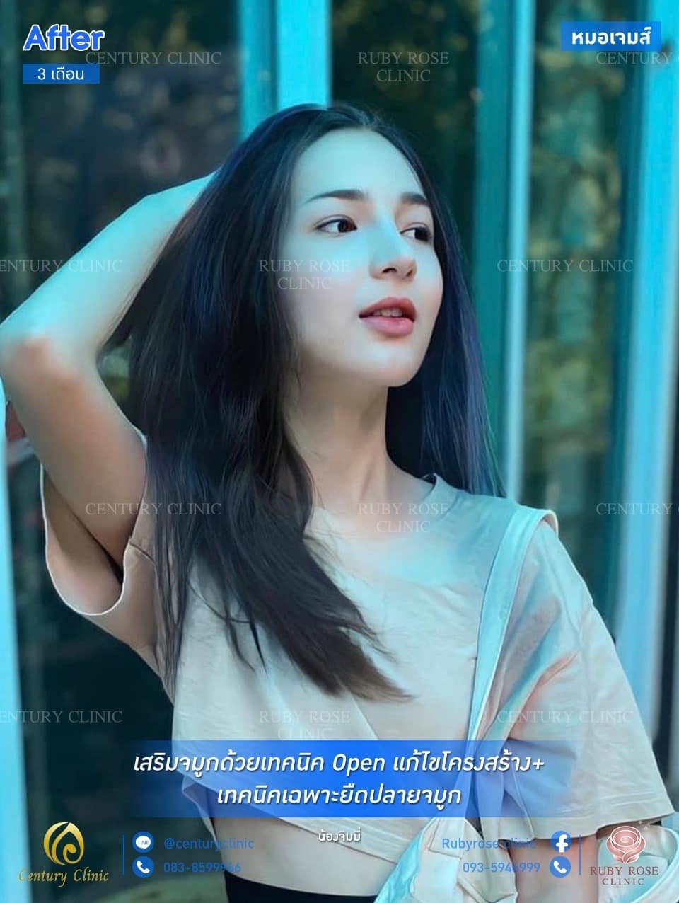 รีวิว เสริมจมูก #119
