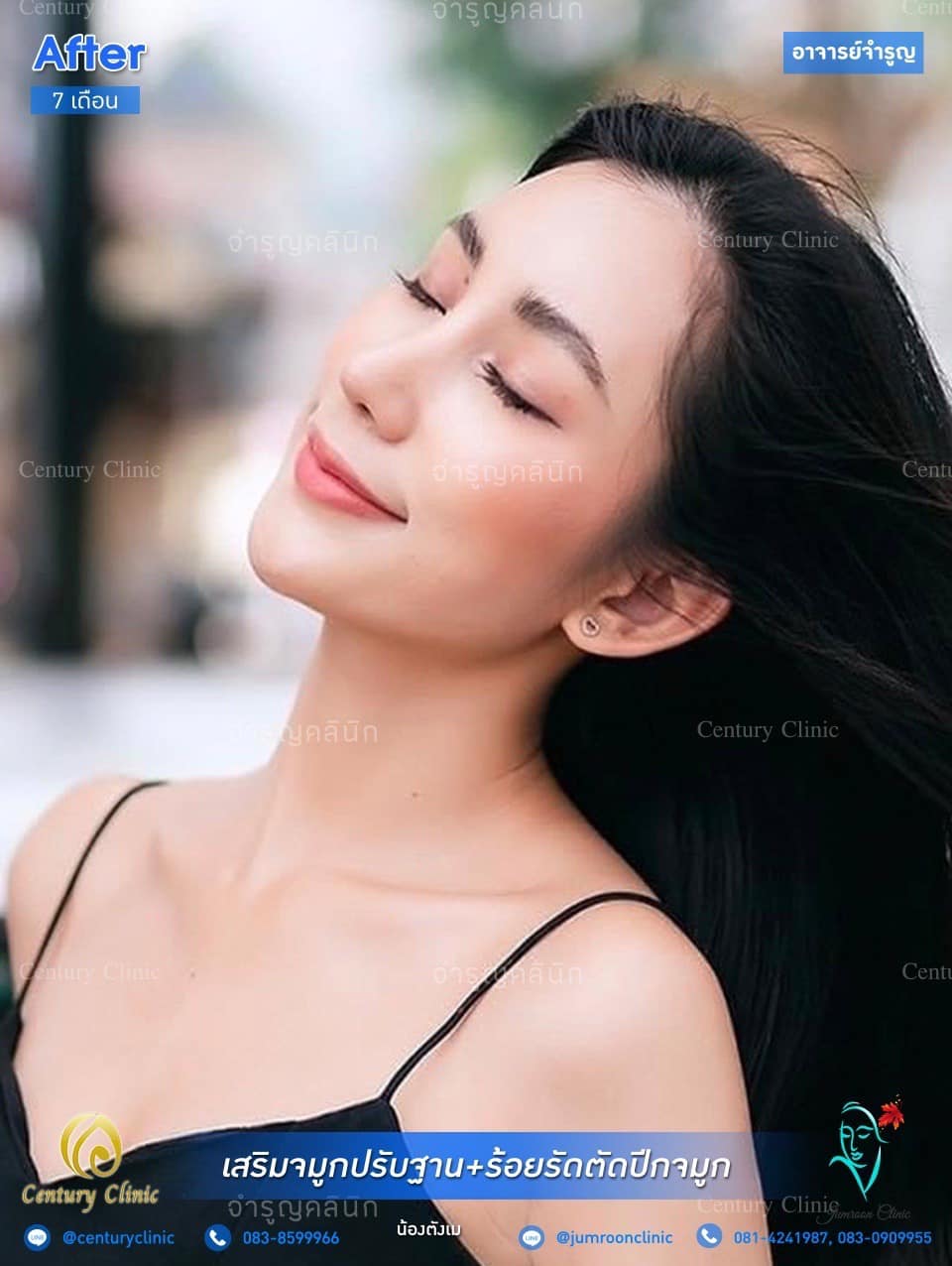 รีวิว เสริมจมูก2 #127
