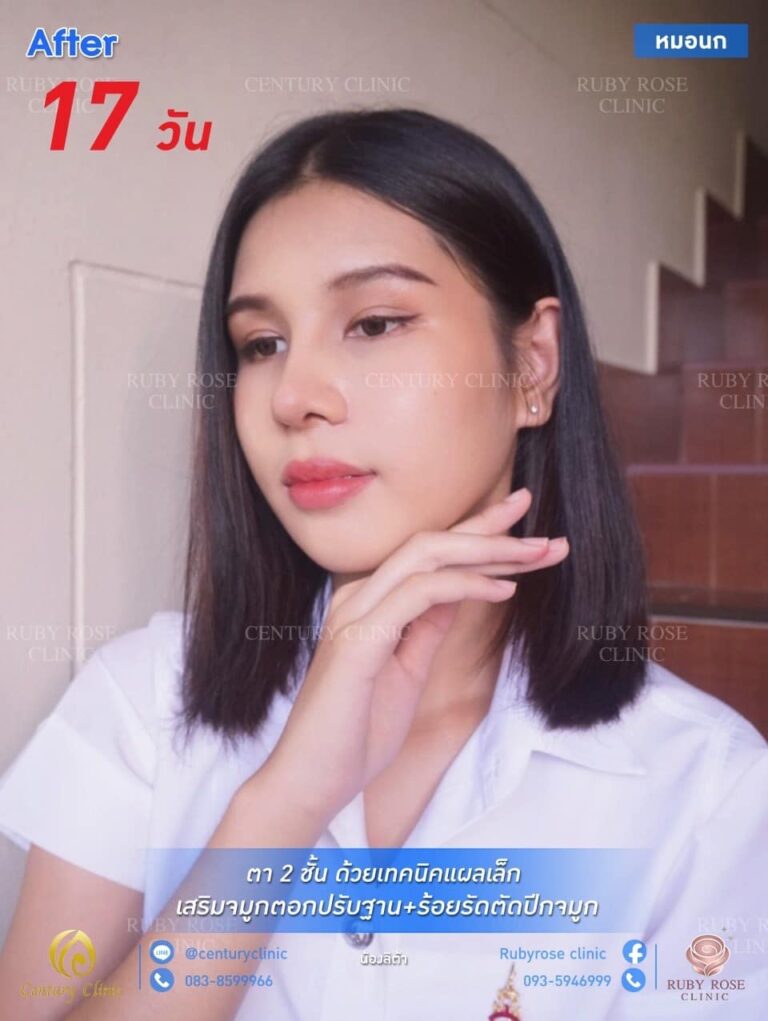 รีวิว เสริมจมูก #133