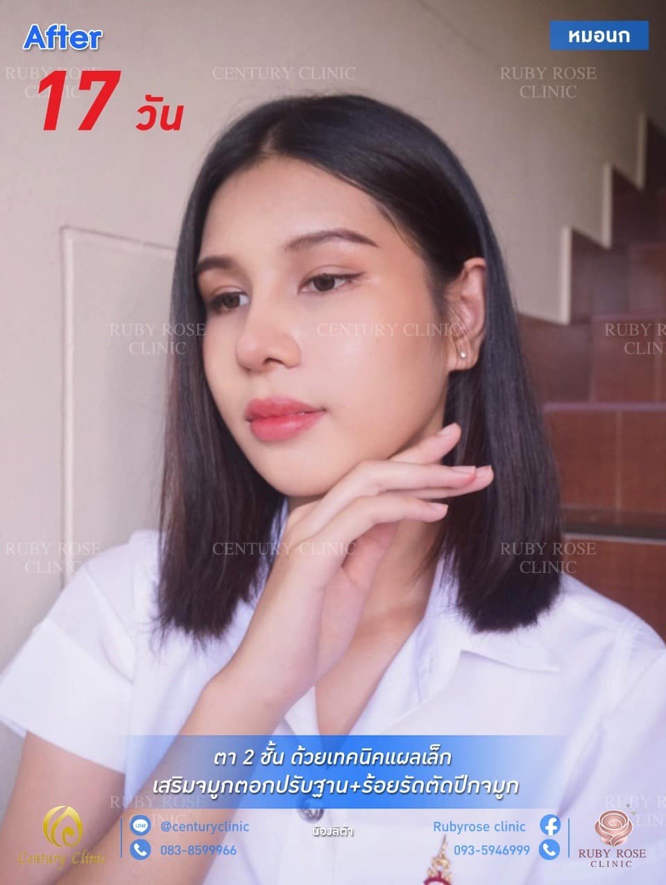 รีวิว เสริมจมูก #133