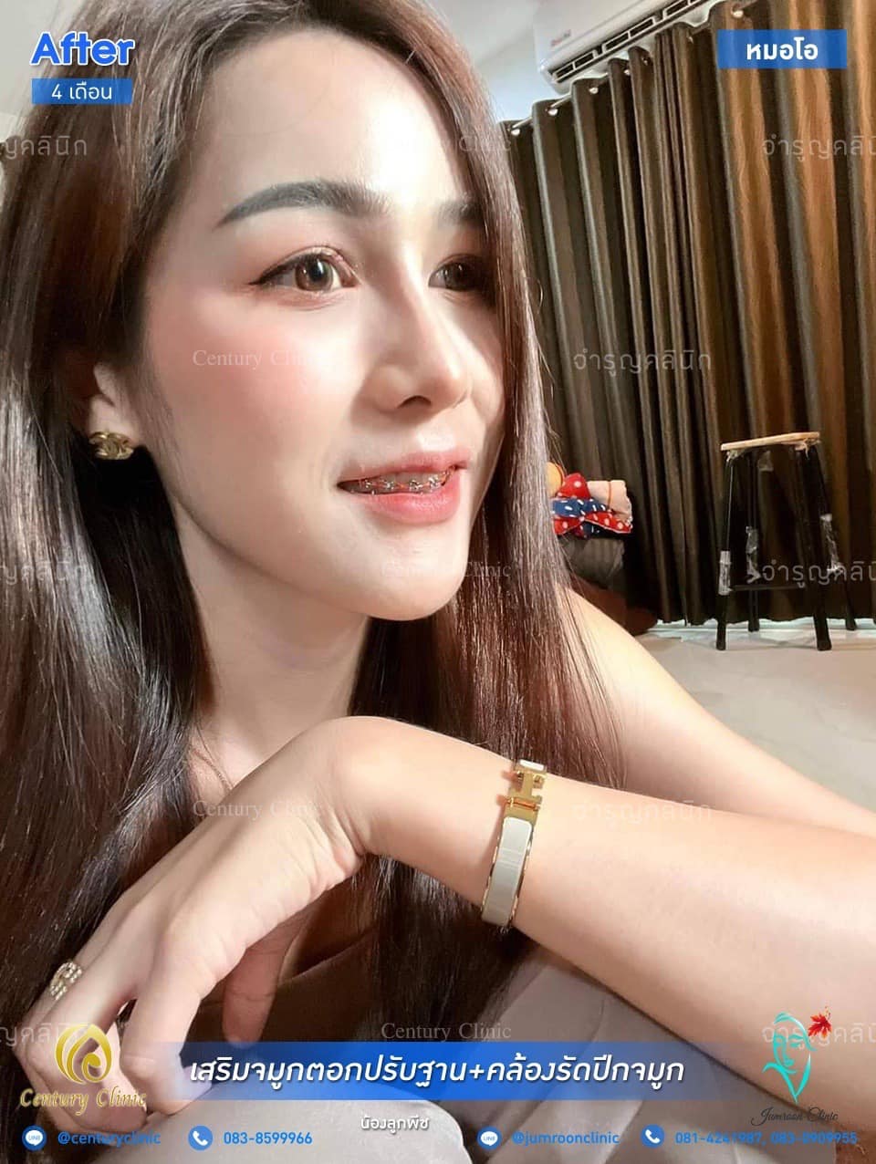 รีวิว เสริมจมูก #134