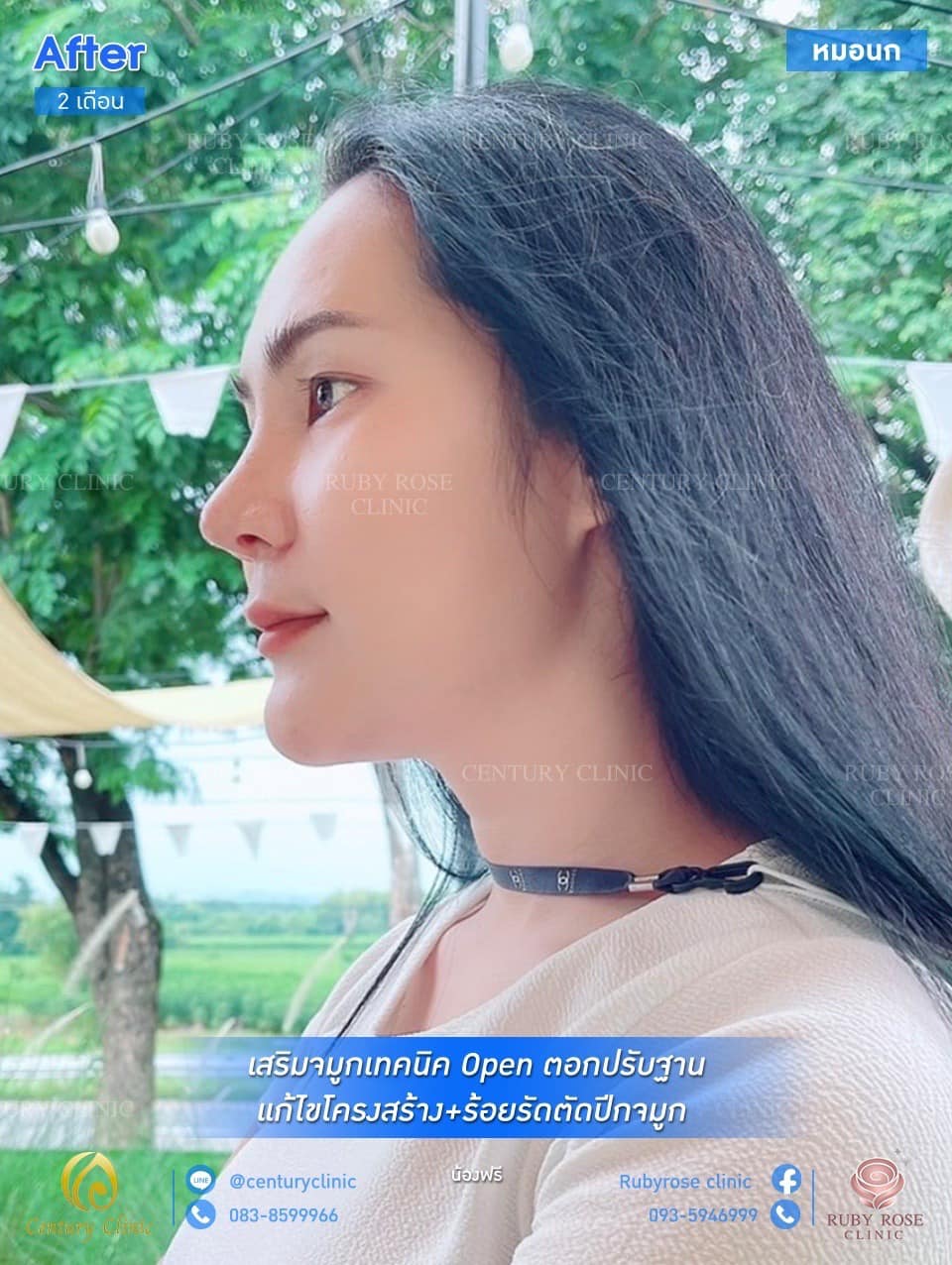 รีวิว เสริมจมูก #37