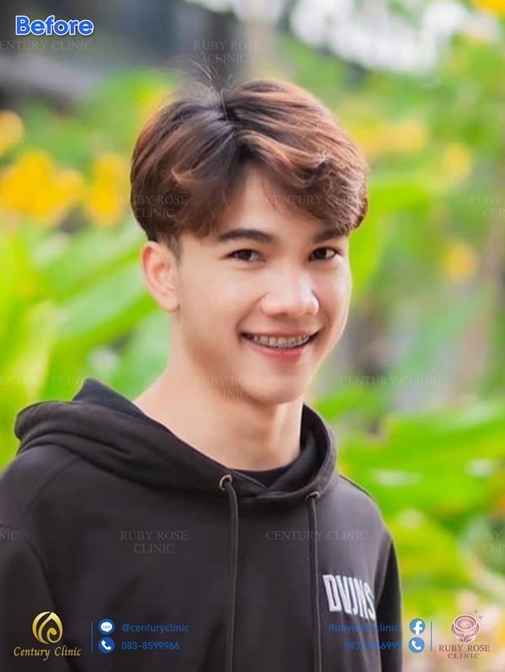 รีวิว เสริมจมูก #57 , Century Clinic Thailand รีวิว เสริมจมูก #57
