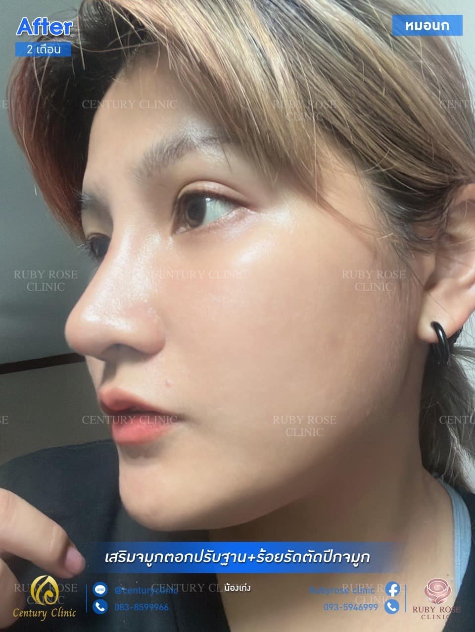 รีวิว เสริมจมูก #60 , Century Clinic Thailand รีวิว เสริมจมูก #60