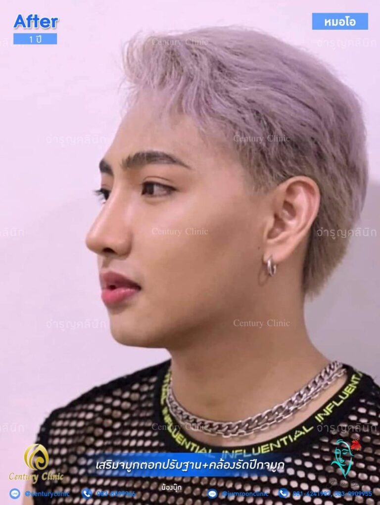 รีวิว เสริมจมูก #75