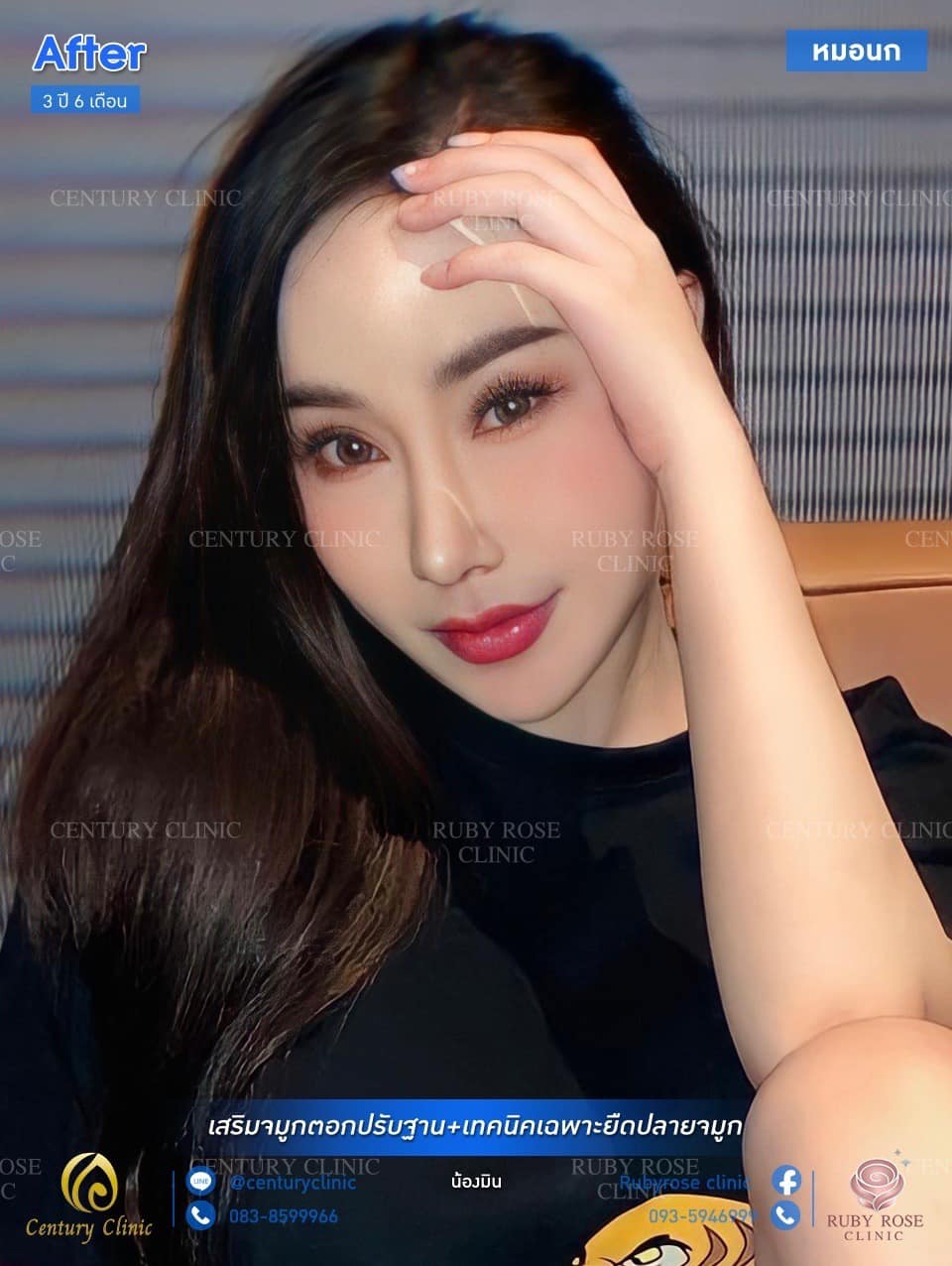 รีวิว เสริมจมูก #80