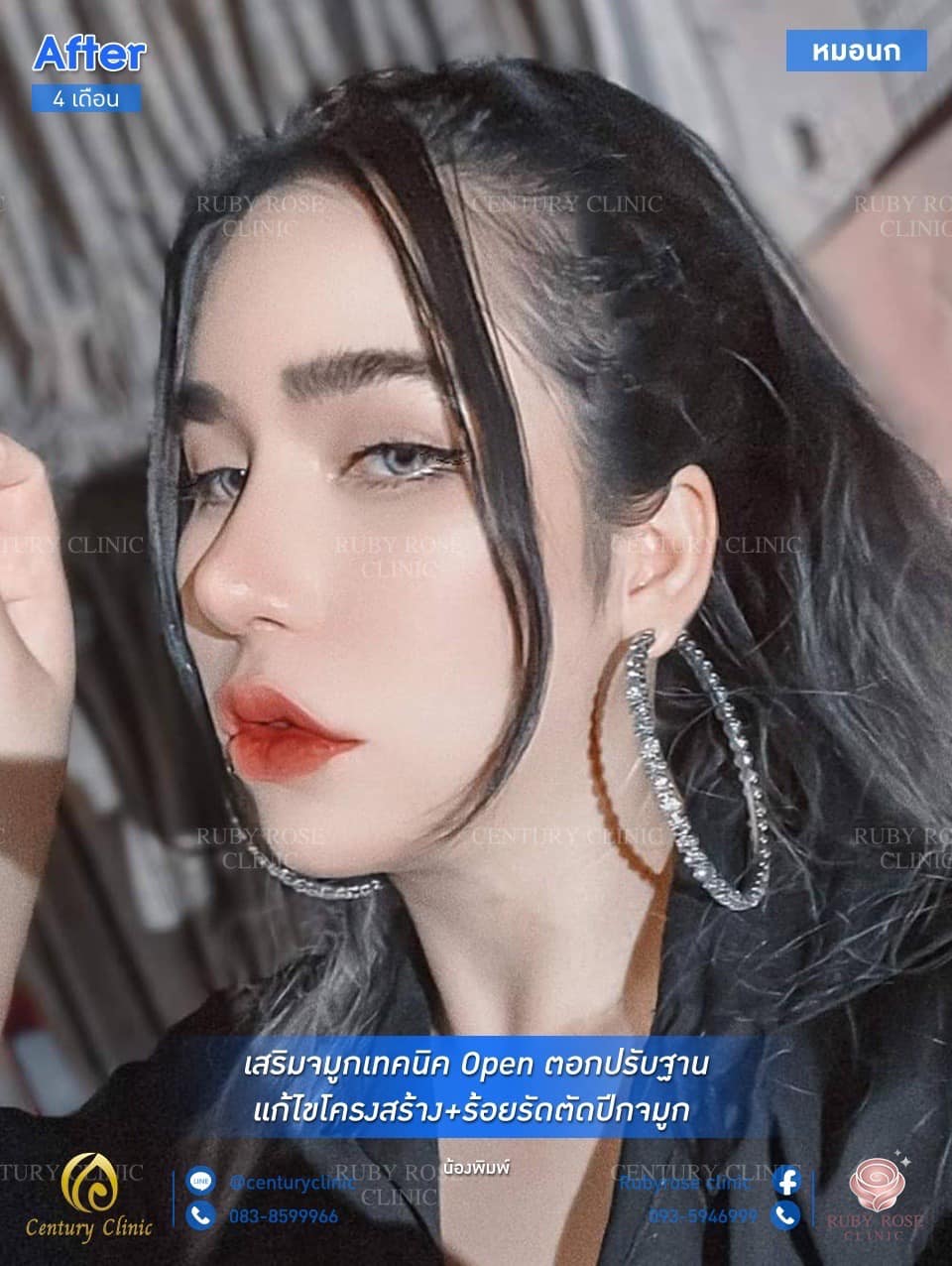 รีวิว เสริมจมูก #83