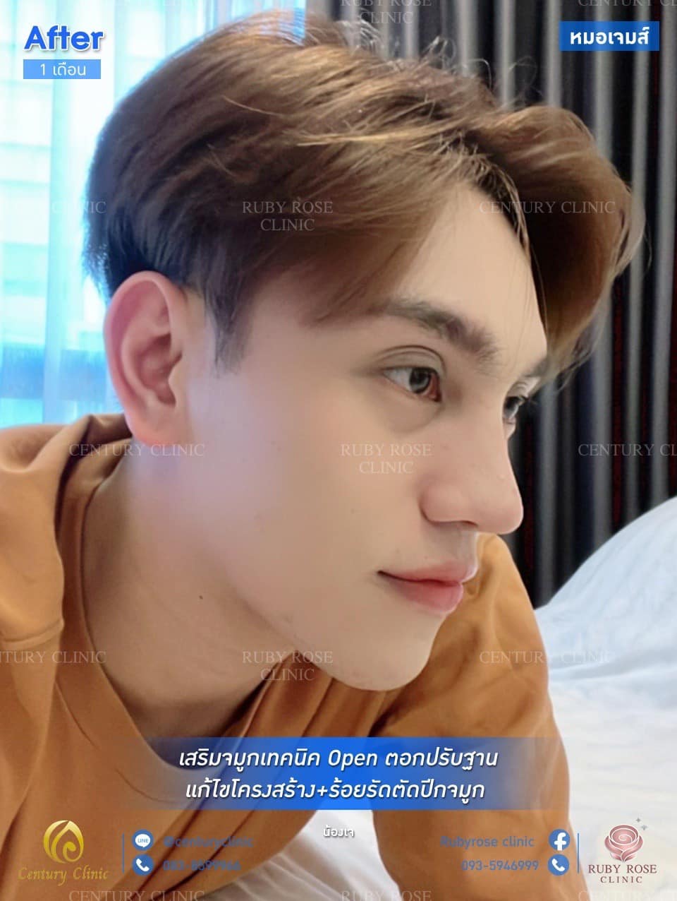 รีวิว เสริมจมูก #90 , Century Clinic Thailand รีวิว เสริมจมูก #90