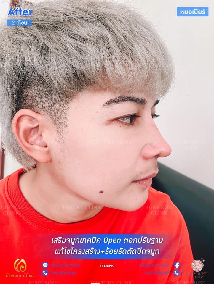 รีวิว เสริมจมูก1 #108