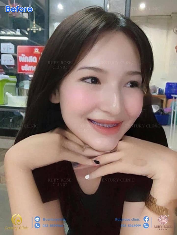 รีวิว เสริมจมูก1 #119