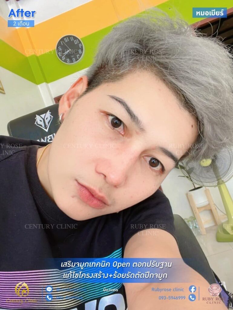 รีวิว เสริมจมูก1 #24