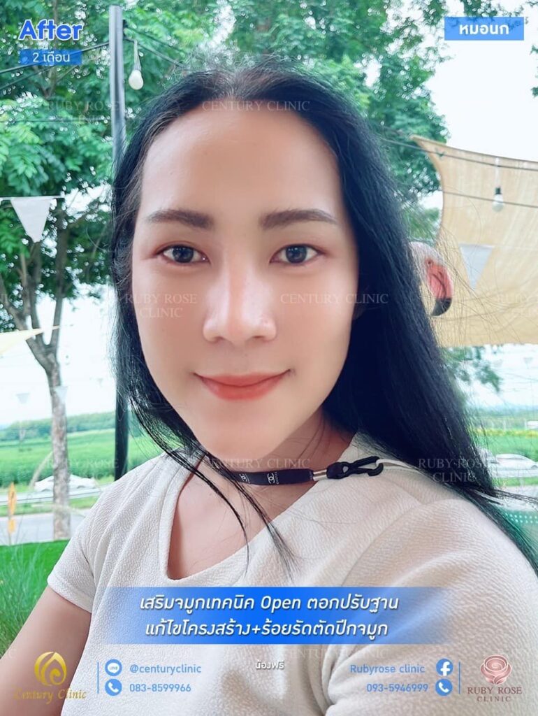 รีวิว เสริมจมูก1 #37
