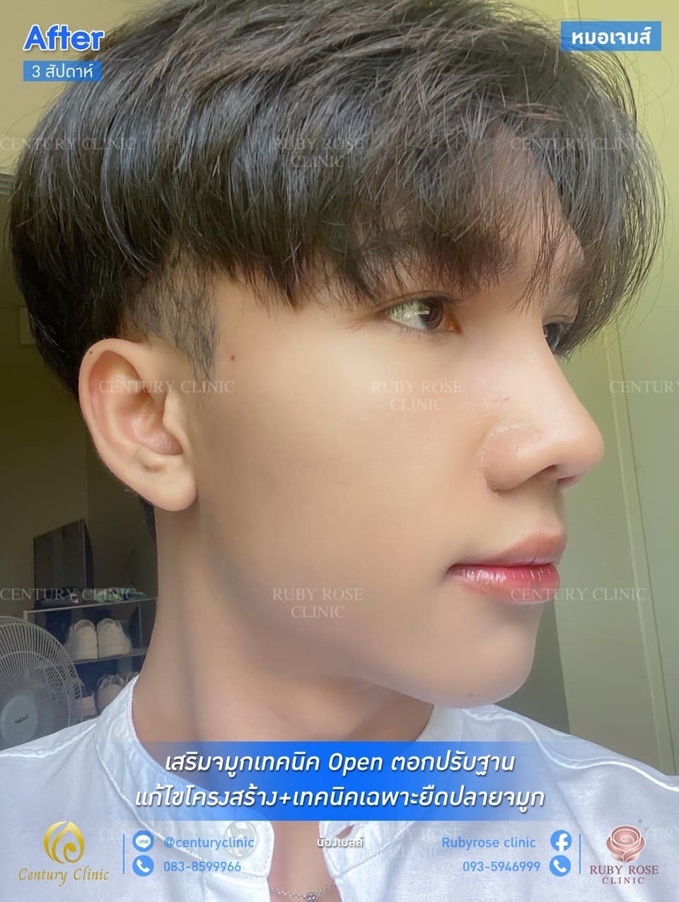 รีวิว เสริมจมูก #57 , Century Clinic Thailand รีวิว เสริมจมูก1 #57