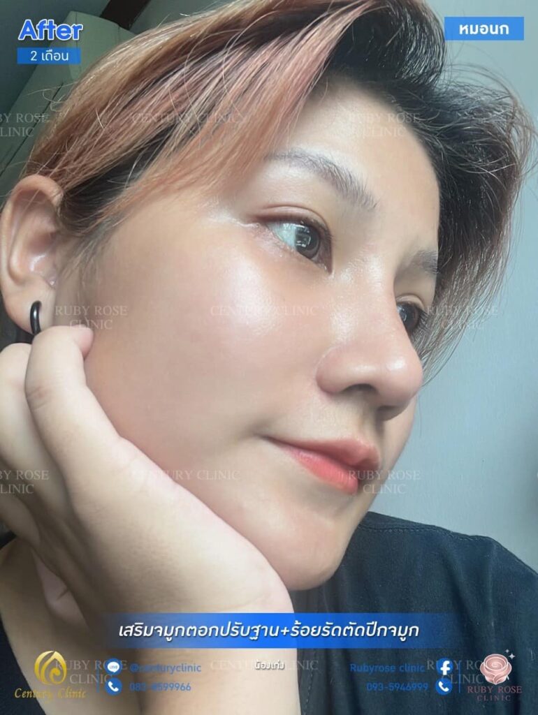 รีวิว เสริมจมูก #60 , Century Clinic Thailand รีวิว เสริมจมูก1 #60