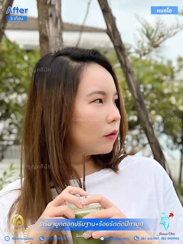 รีวิว เสริมจมูก1 #74