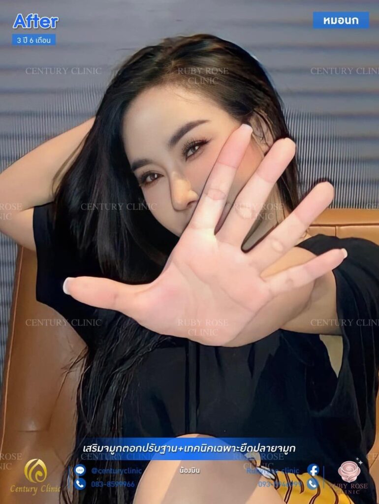 รีวิว เสริมจมูก1 #80