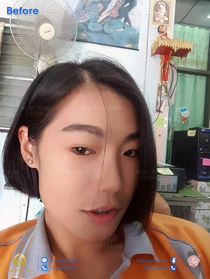 รีวิว เสริมจมูก1 #95