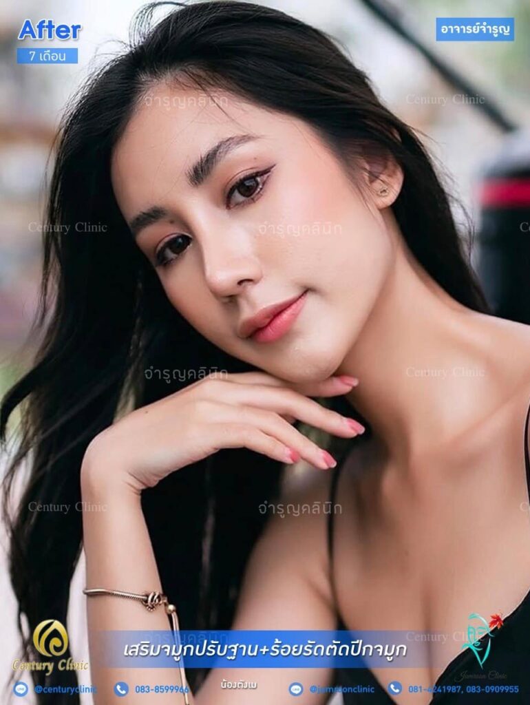 รีวิว เสริมจมูก2 #127