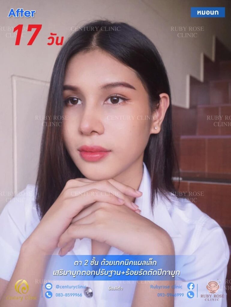รีวิว เสริมจมูก2 #133