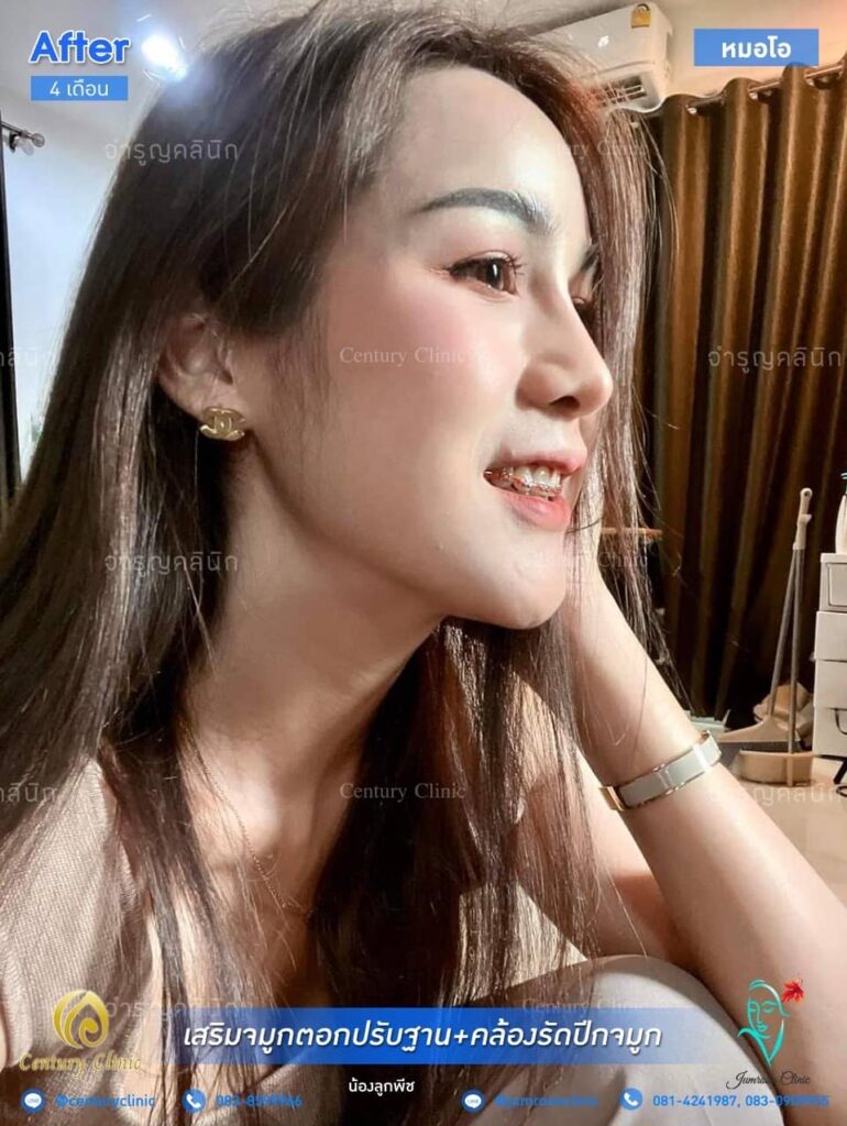 รีวิว เสริมจมูก2 #134