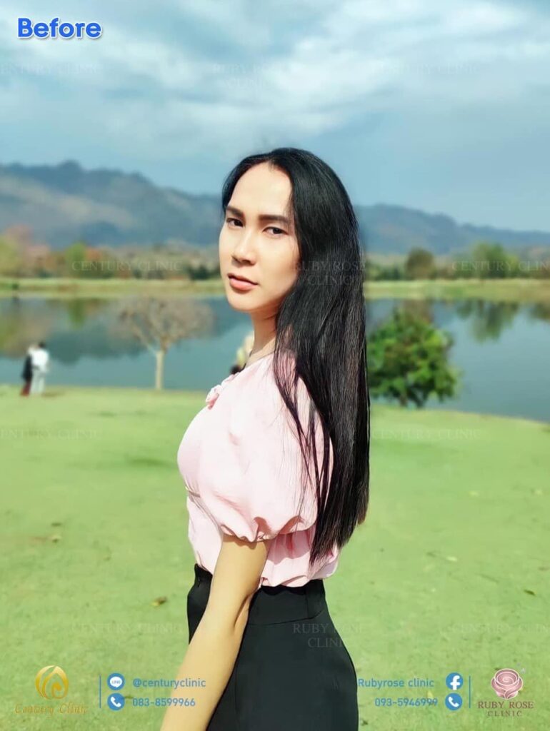 รีวิว เสริมจมูก2 #37