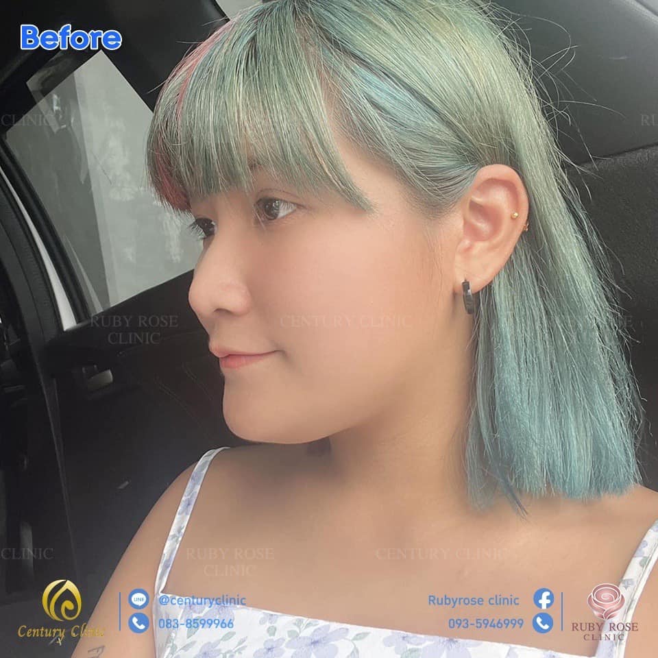 รีวิว เสริมจมูก #60 , Century Clinic Thailand รีวิว เสริมจมูก2 #60