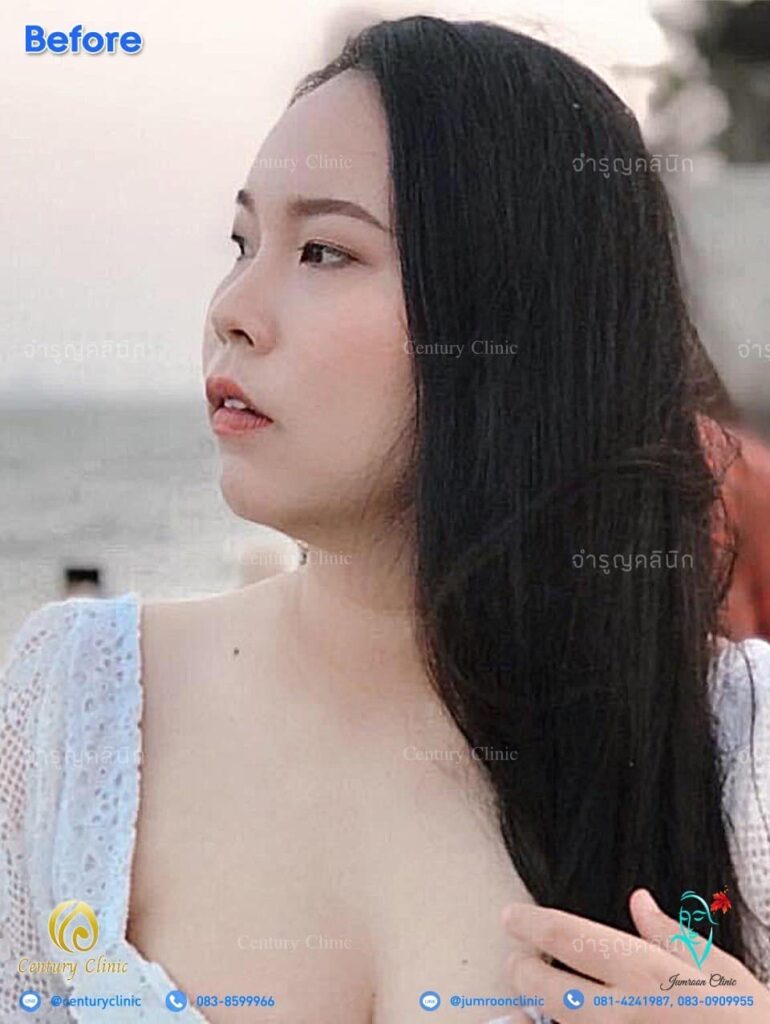 รีวิว เสริมจมูก2 #74