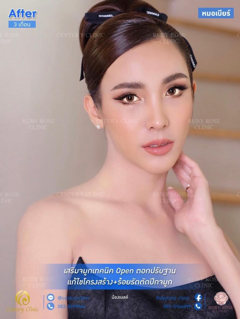 รีวิว เสริมจมูก 1#129