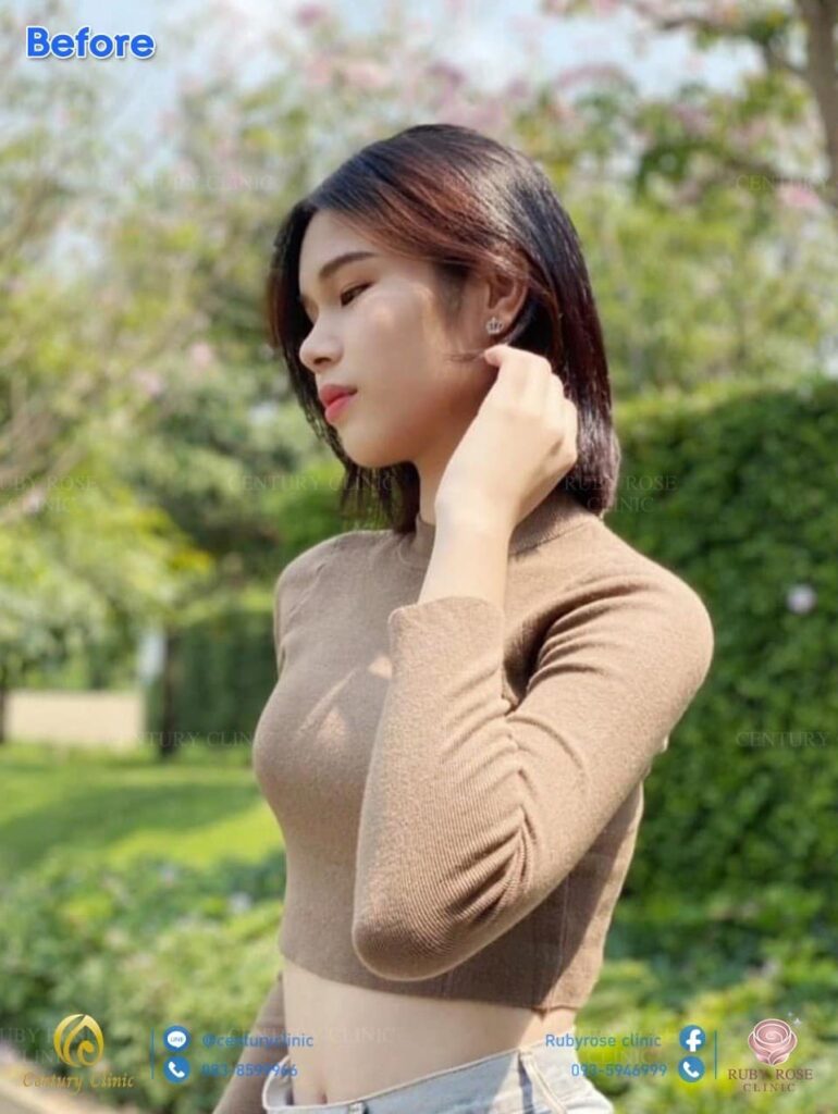 รีวิว เสริมจมูก3 #133